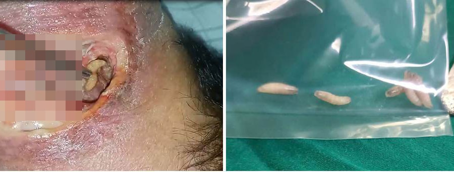 Cảnh báo từ ca bệnh cổ hoại tử trầm trọng