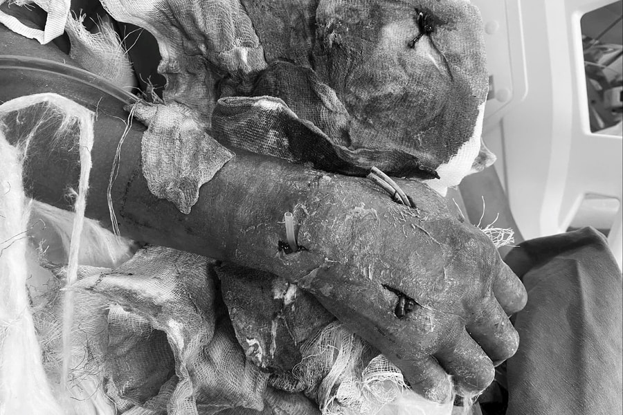 Bệnh nhân uốn ván suy đa cơ quan được cứu sống ngoạn mục