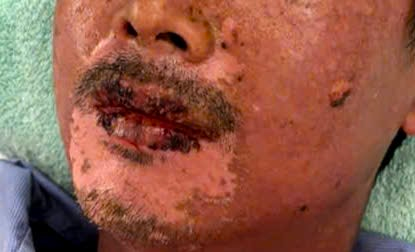 Bệnh nhân bỏng rát toàn thân, mù tạm thời vì… silicon chống dột