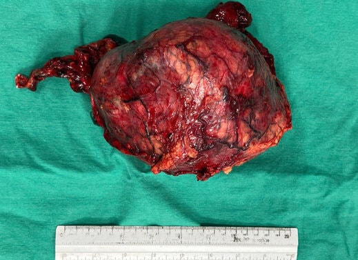 Phẫu thuật thành công khối u thận khổng lồ xâm lấn tĩnh mạch chủ dưới