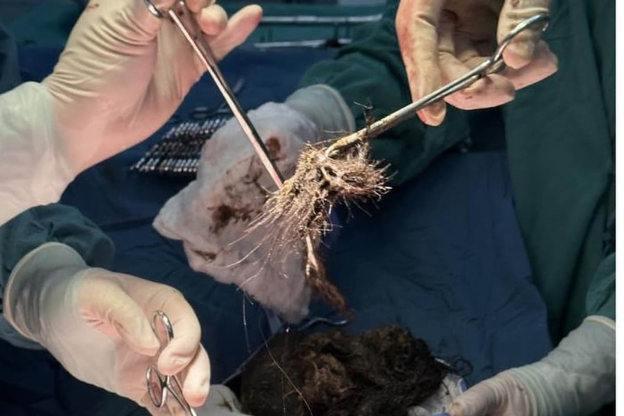 Phẫu thuật lấy 2 kg tóc trong dạ dày thiếu nữ