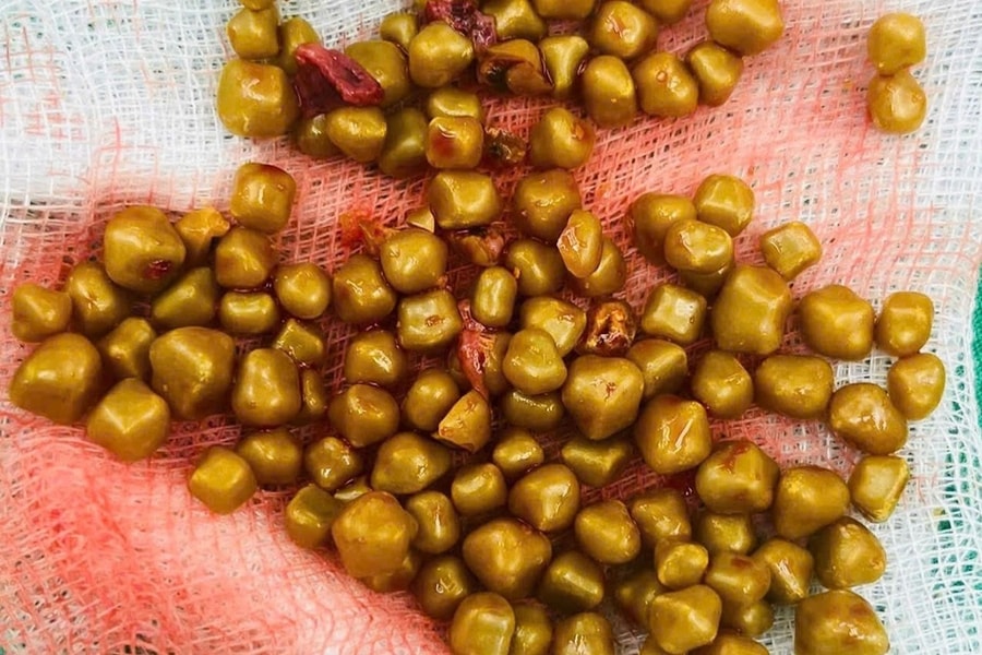 Sốc với 100 viên sỏi chật kín túi mật bệnh nhân nữ