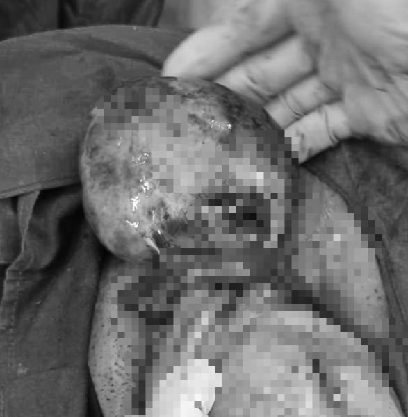 Cháu bé chào đời cùng lúc mẹ được cắt bỏ khối u nang xoắn hoại tử