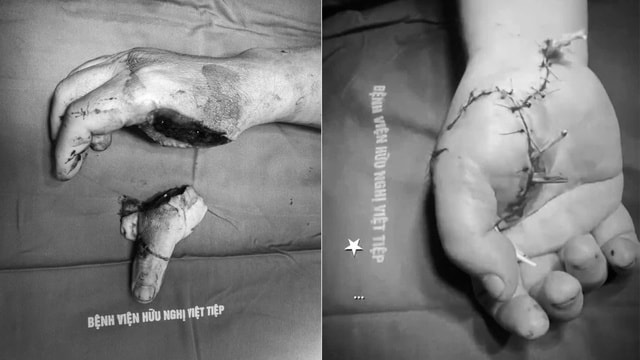 Các bác sĩ kịp thời nối vi phẫu cho cán bộ công an bị chém đứt bàn tay khi làm nhiệm vụ