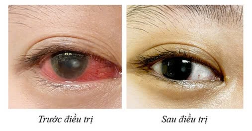 Cô gái 20 tuổi bị loét giác mạc vì lạm dụng kính áp tròng thay kính thường