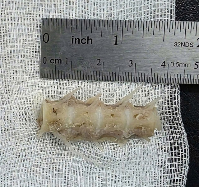 Xương cá dài 4cm găm chặt cổ họng cụ ông 99 tuổi