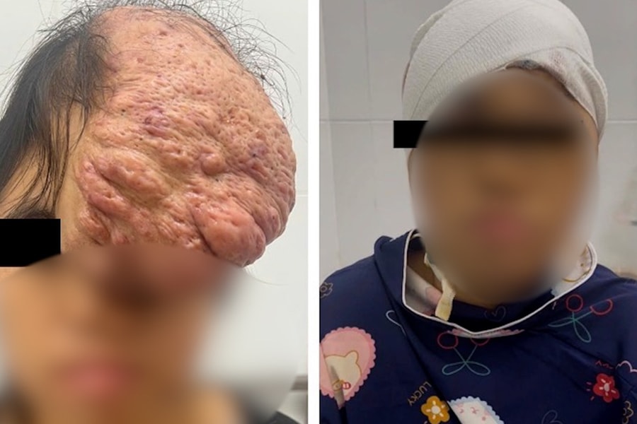 Cắt bỏ khối u sụn xương sọ khổng lồ trên gương mặt bệnh nhân sau 15 năm