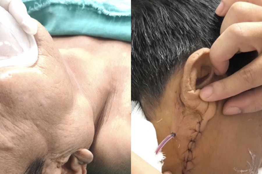 Bệnh nhân 70 tuổi tái phát u tuyến nước bọt sau 10 năm, suýt liệt mặt