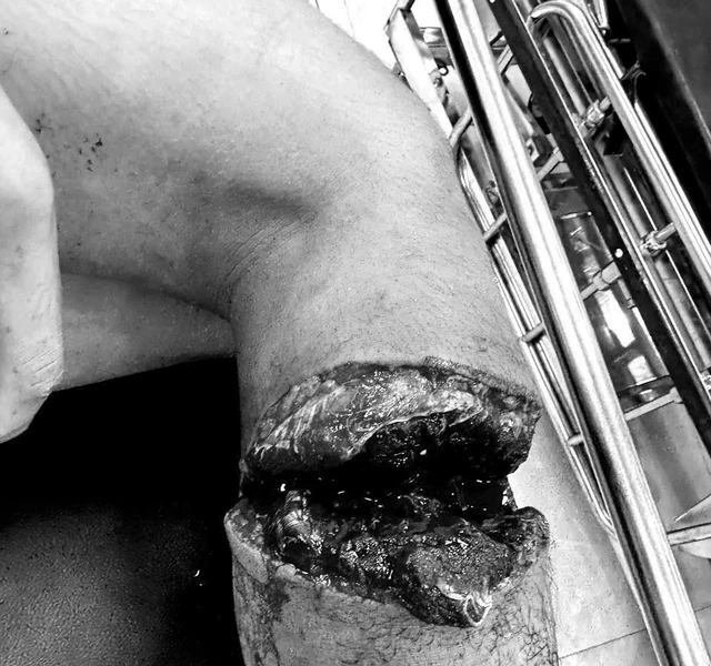 Cẳng chân gần lìa khỏi cơ thể, nam sinh 15 tuổi được bác sĩ cứu ngoạn mục