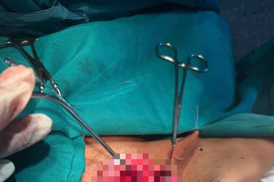 Nam sinh 17 tuổi thoát chết sau khi bị đứt khí quản vì vướng dây điện giữa đường