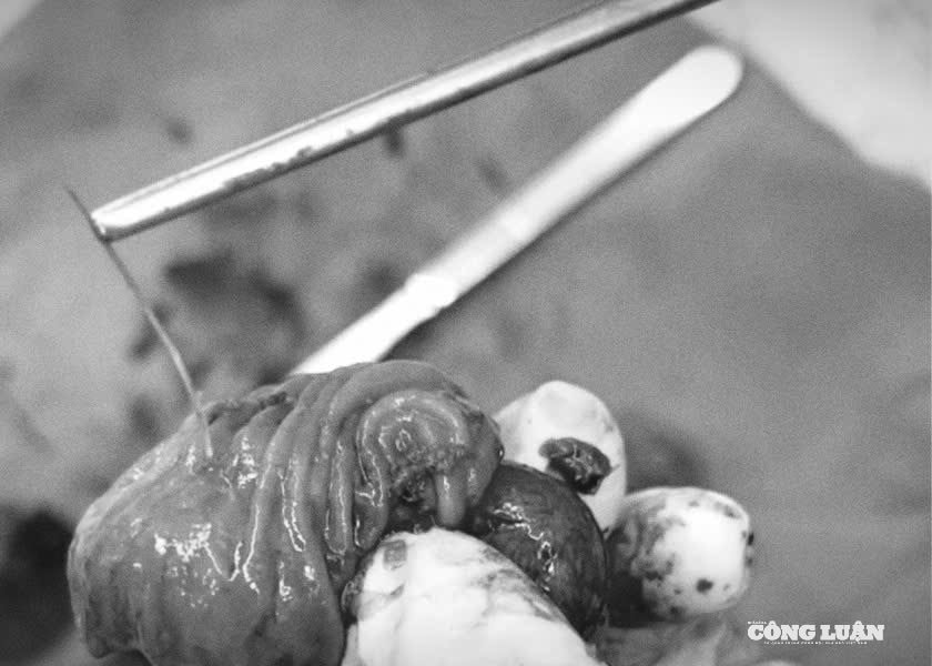 Xương cá 4 cm đâm thủng ruột non, người đàn ông 33 tuổi suýt tử vong