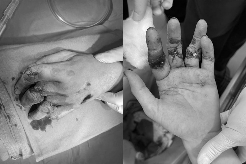 Nối sống ngón tay dập nát của bệnh nhân 24 tuổi