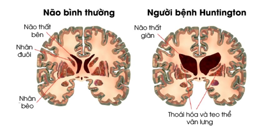 Lần đầu tiên điều trị thành công bệnh di truyền múa giật Huntington