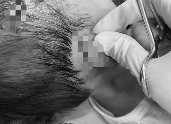 Bé gái 19 tháng tuổi bị chó cắn nguy kịch, phải tiêm huyết thanh kháng dại