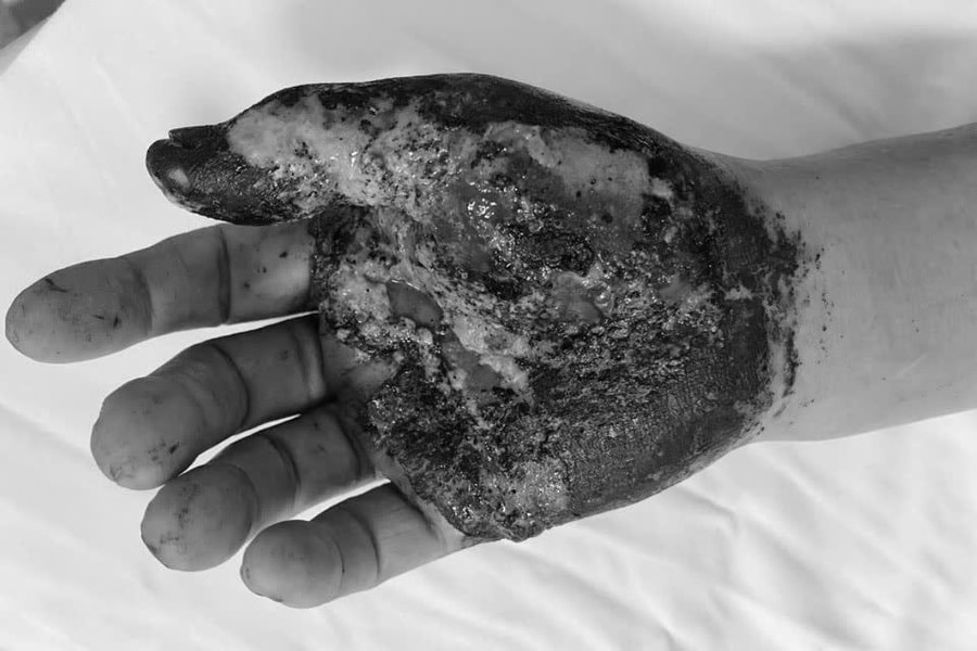 Nguy cơ mất bàn tay vì tin vào lá thuốc dân gian