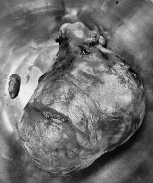 Cắt bỏ khối u xơ tử cung gần 3kg ở nữ bệnh nhân 47 tuổi