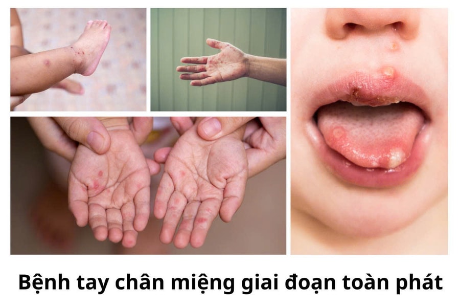 Bệnh tay chân miệng leo thang, Bộ Y tế yêu cầu khẩn, ngăn chặn dịch lây lan trên diện rộng