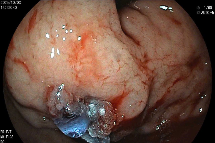 Máu phun thành tia trong dạ dày, người đàn ông nhập viện khẩn cấp