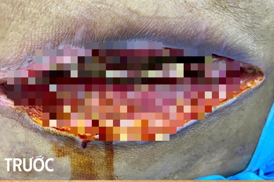 Vết mổ lộ xương, phổi trắng xóa do vi khuẩn kháng thuốc