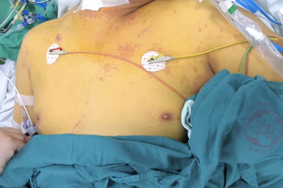 Sau bão lũ, nguy cơ tử vong từ xoắn khuẩn Leptospira tăng cao