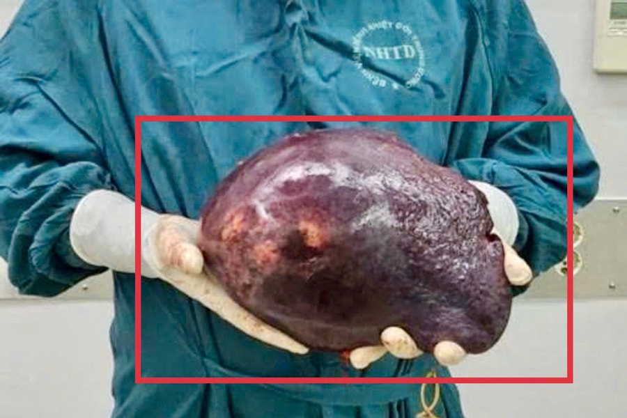 Phẫu thuật thành công khối u chiếm 70% gan, nặng hơn 2,5kg