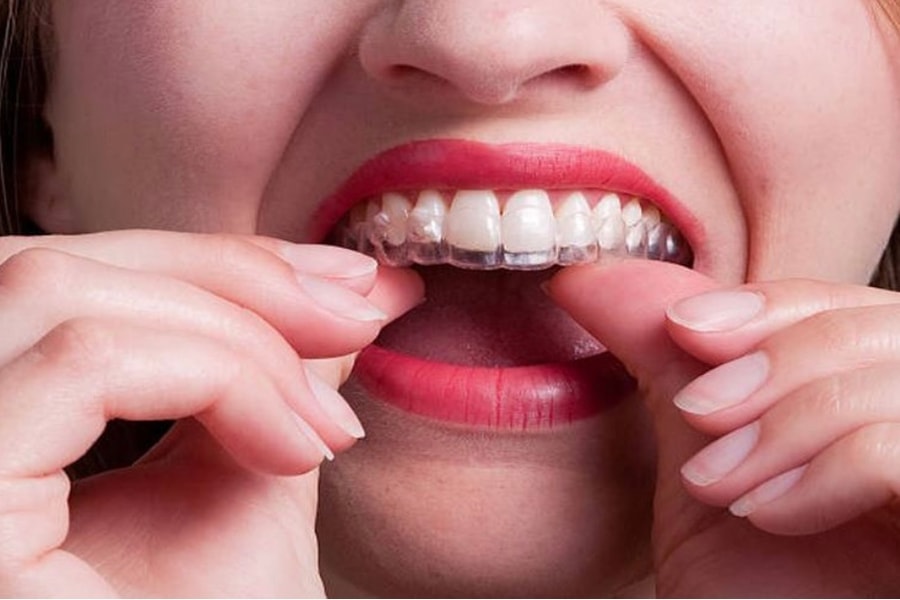 Niềng răng invisalign giá bao nhiêu tại Nha khoa Đăng Lưu?