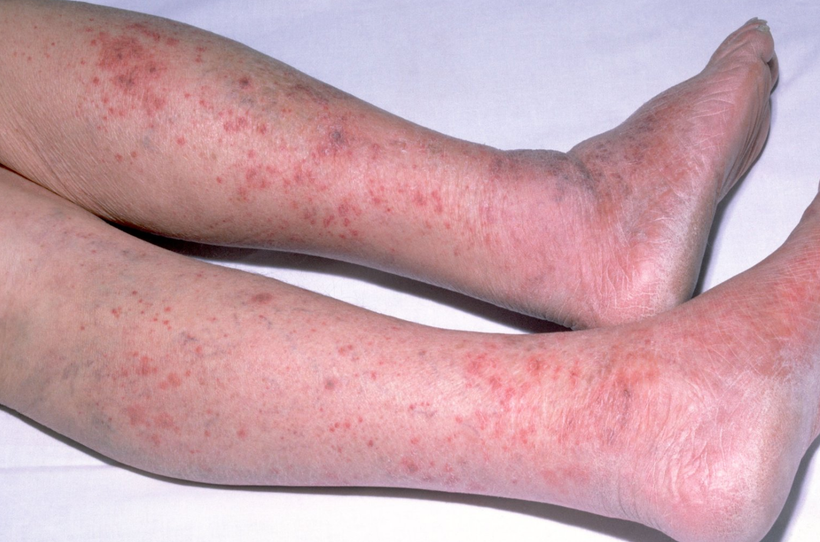 TP HCM cảnh báo khẩn bệnh tấn công chớp nhoáng, có thể cướp đi sinh mạng chỉ trong vài giờ